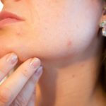 woman showing pimples
