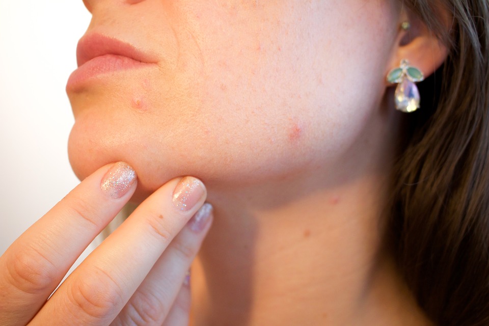 woman showing pimples